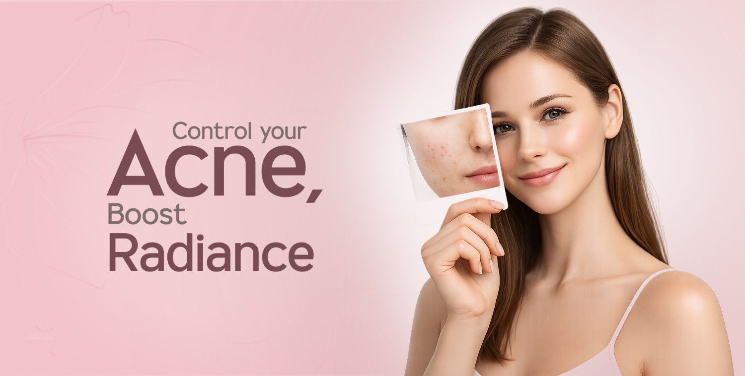 Acne Prone Skin